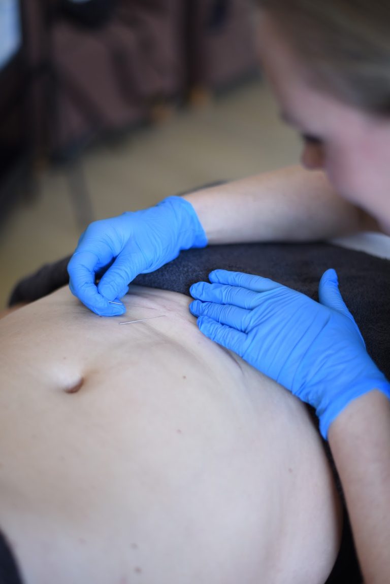 Read more about the article Suchy igłowanie (Dry Needling) – skuteczna metoda leczenia bólu mięśniowego